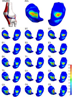 Knee instability caused by altered graft mechanical properties after anterior cruciate ligament reconstruction: the early onset of osteoarthritis?